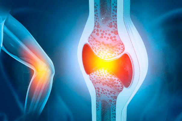 Prevence onemocnění kloubů