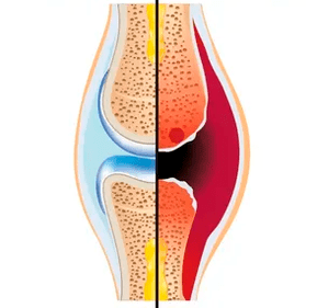 Struktura zdravého a opotřebovaného kloubu s označením chrupavkové tkáně a synoviální tekutiny